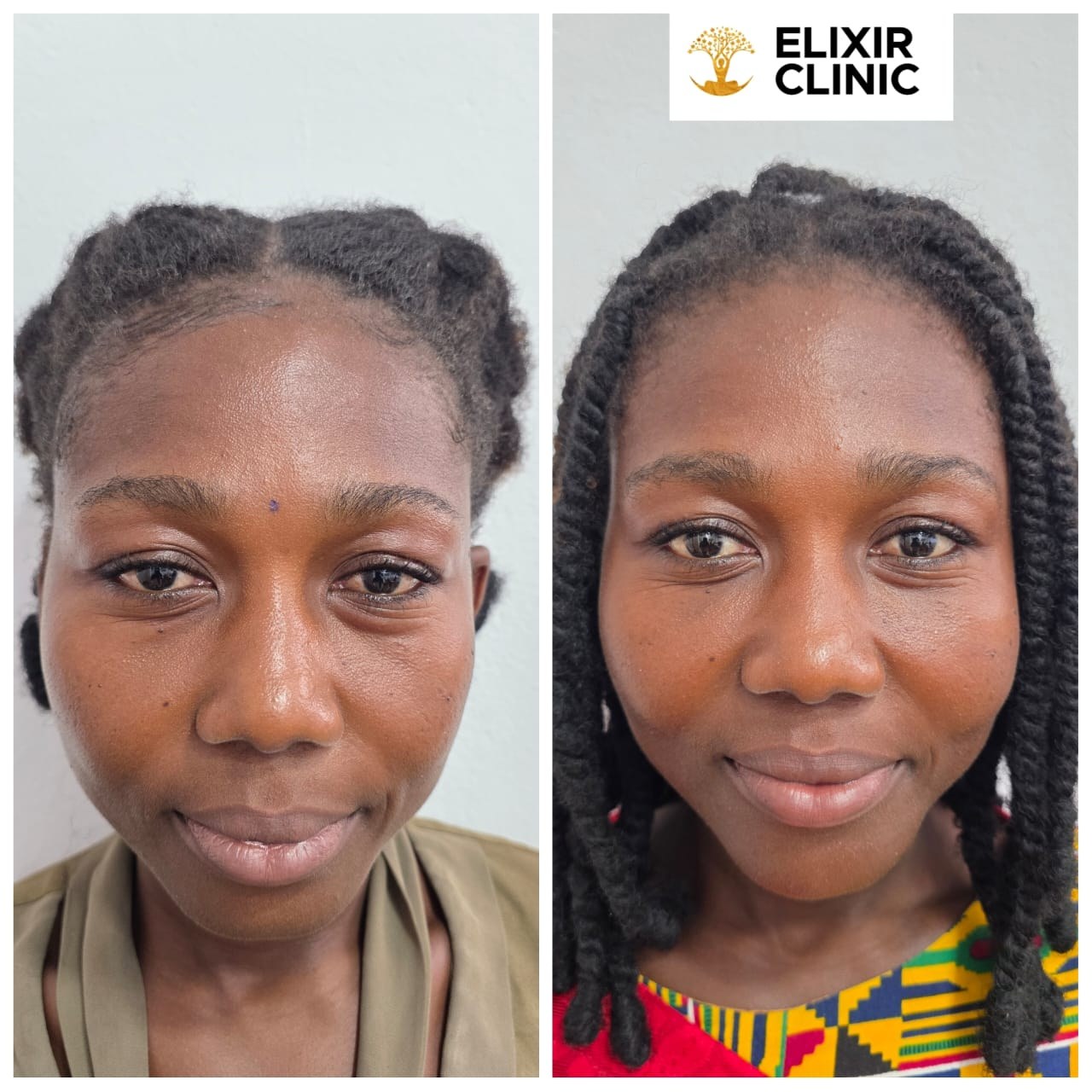 Before and after photographs of a woman taken at Elixir Clinic, shown side by side.