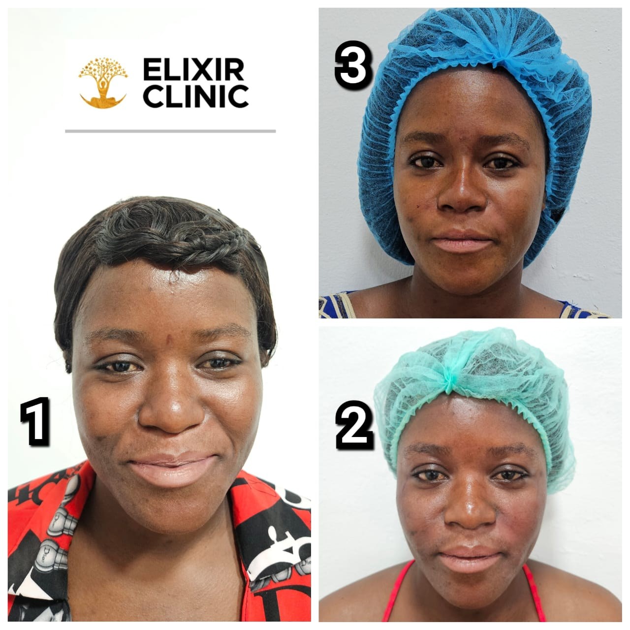 Three numbered photographs of a woman at Elixir Clinic showing her face at different stages of a facial treatment plan.