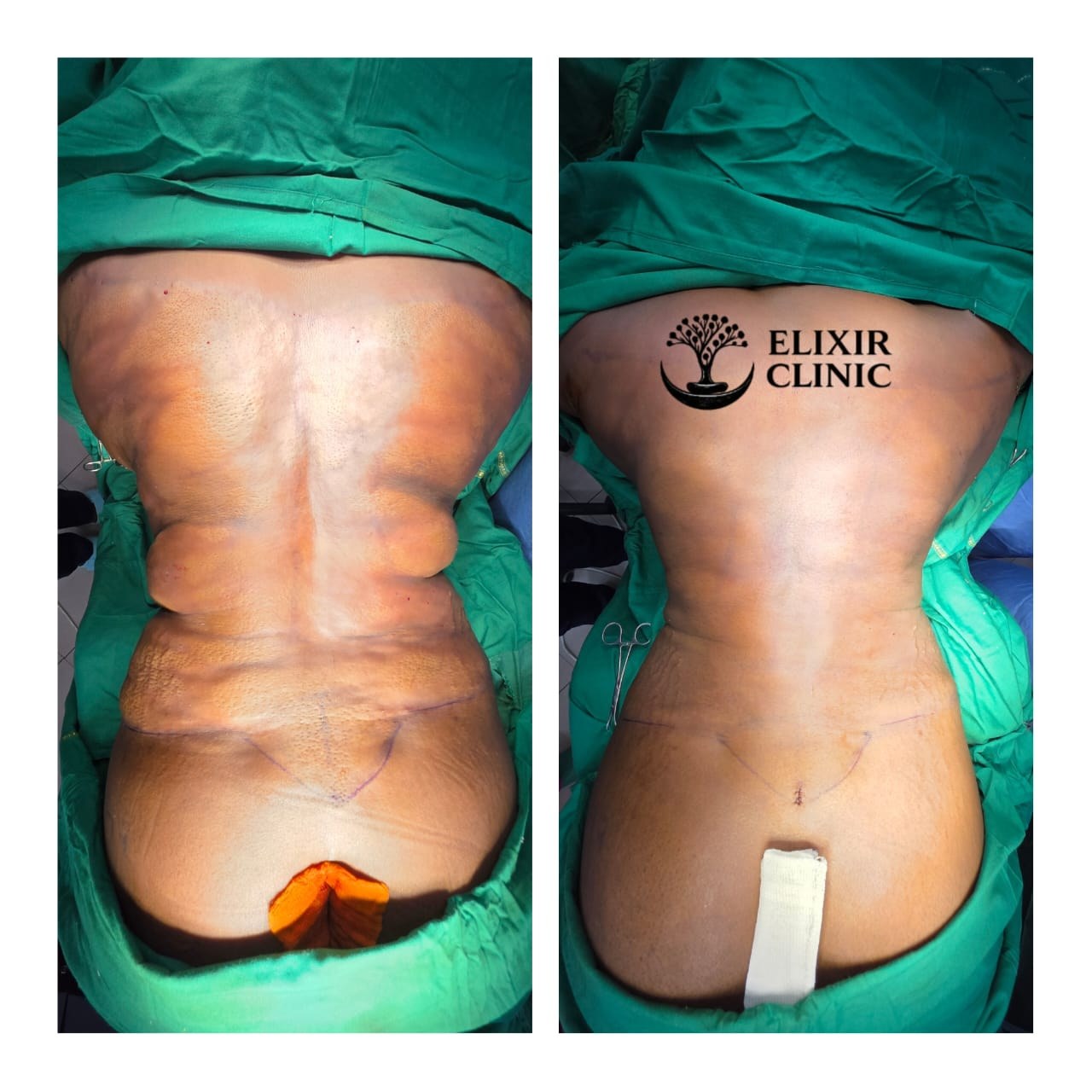 Before and after photographs of a patient’s back on a treatment table at Elixir Clinic, taken from above.