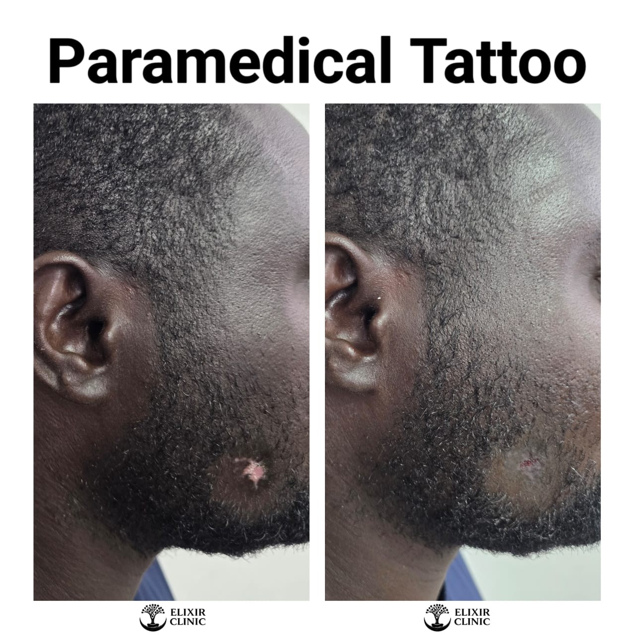 Before and after photographs of a man’s cheek at Elixir Clinic, labelled “Paramedical Tattoo”.