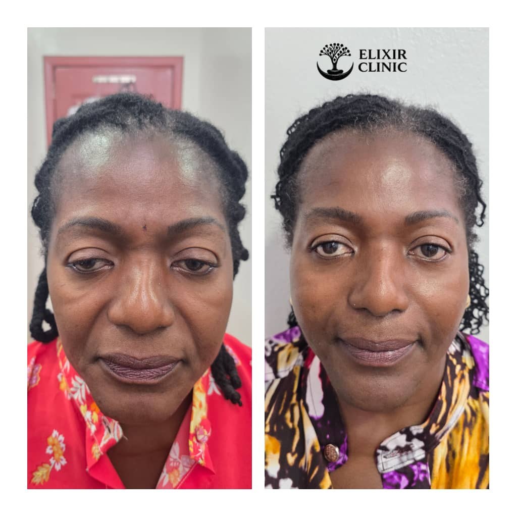 Before and after photographs of a smiling woman with locs, taken at Elixir Clinic and shown side by side.
