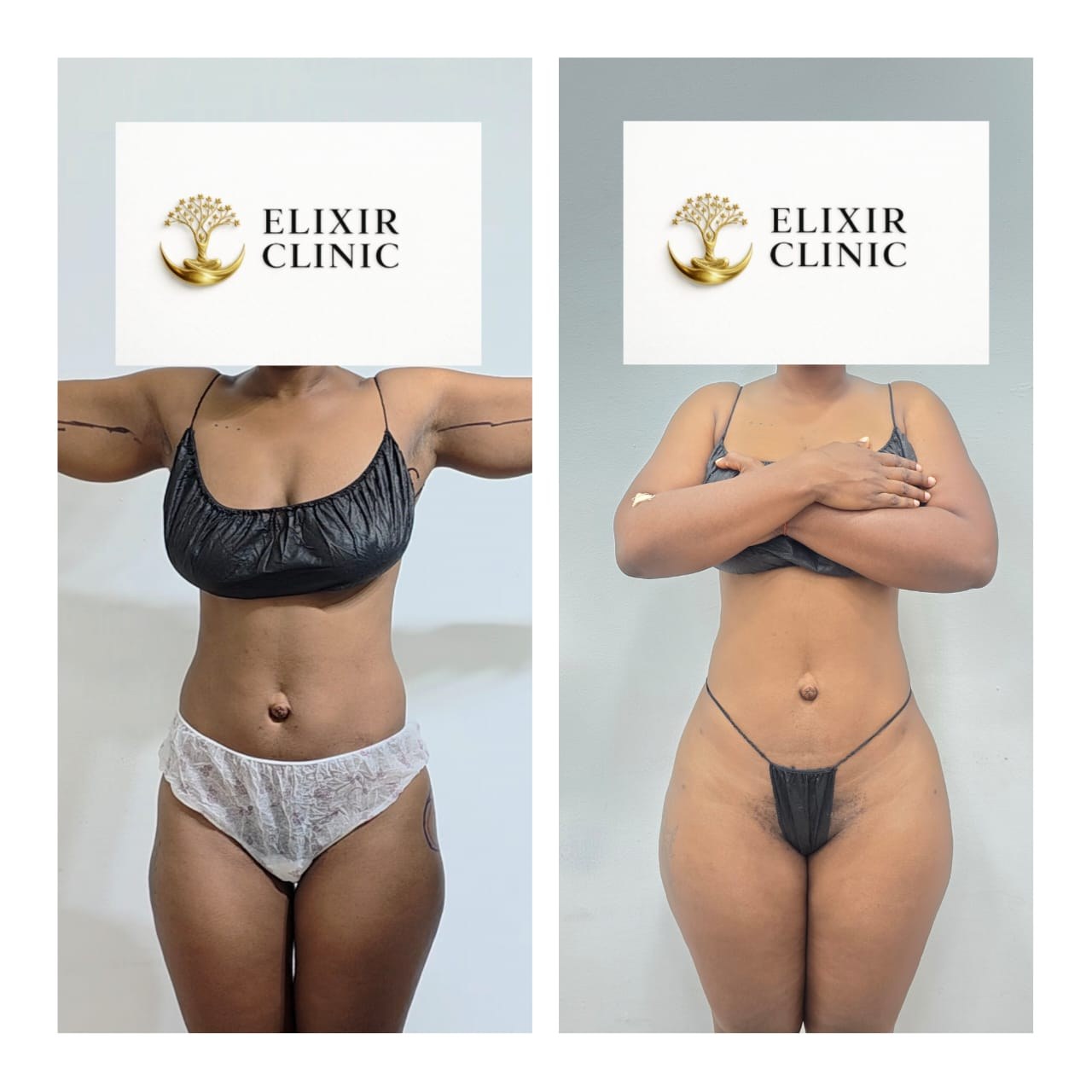 Before and after photographs of a patient’s torso at Elixir Clinic, with the face covered by the clinic’s branding.