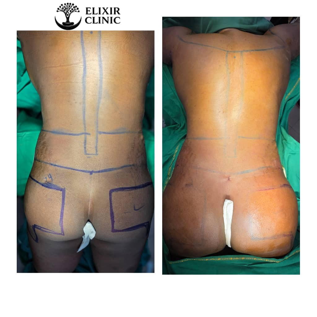 Before and after photographs of a patient’s back on a treatment table at Elixir Clinic, shown side by side.
