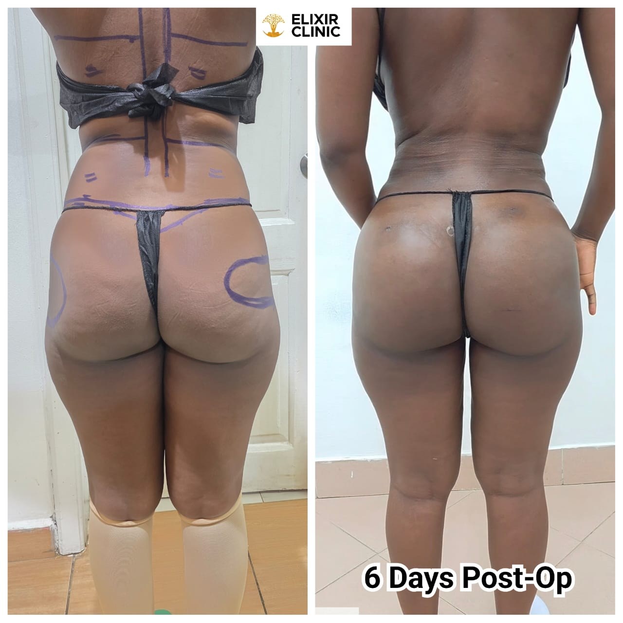 Before and after photographs of a patient’s lower body, labelled “6 Days Post-Op”, taken at Elixir Clinic.