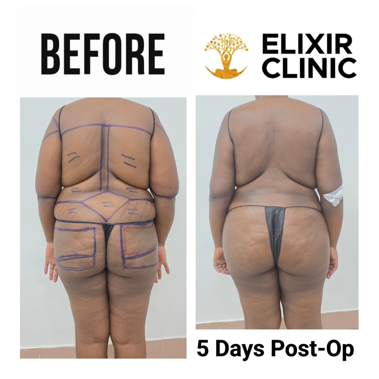 Before and after photographs of a patient’s back, labelled “5 Days Post-Op”, taken at Elixir Clinic.