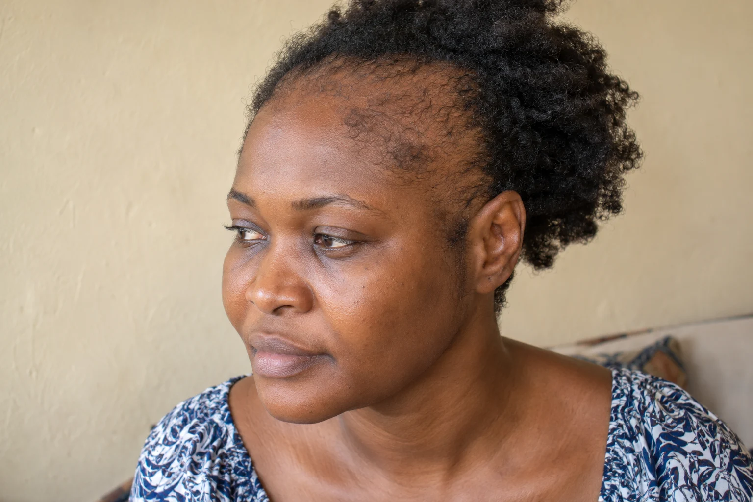 African woman with thinning at the temples and short hairs along the front hairline.