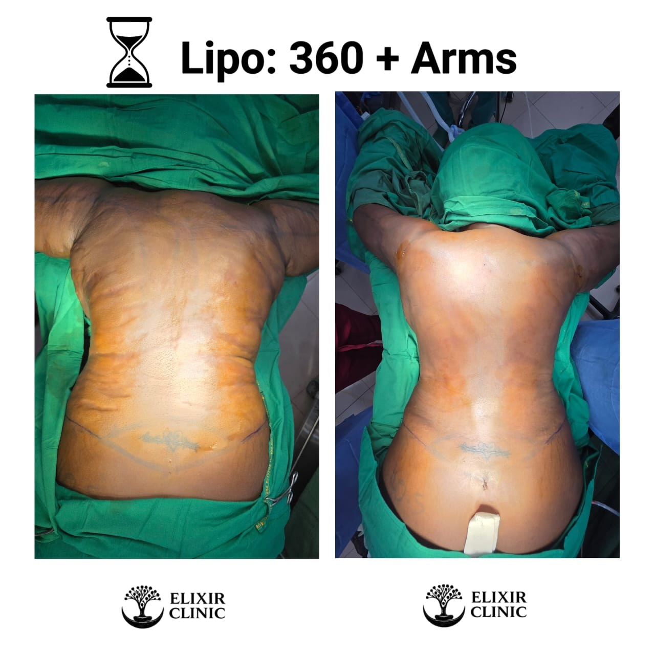 Before and after photographs of a patient’s back on a treatment table at Elixir Clinic, labelled “Lipo: 360 + Arms”.