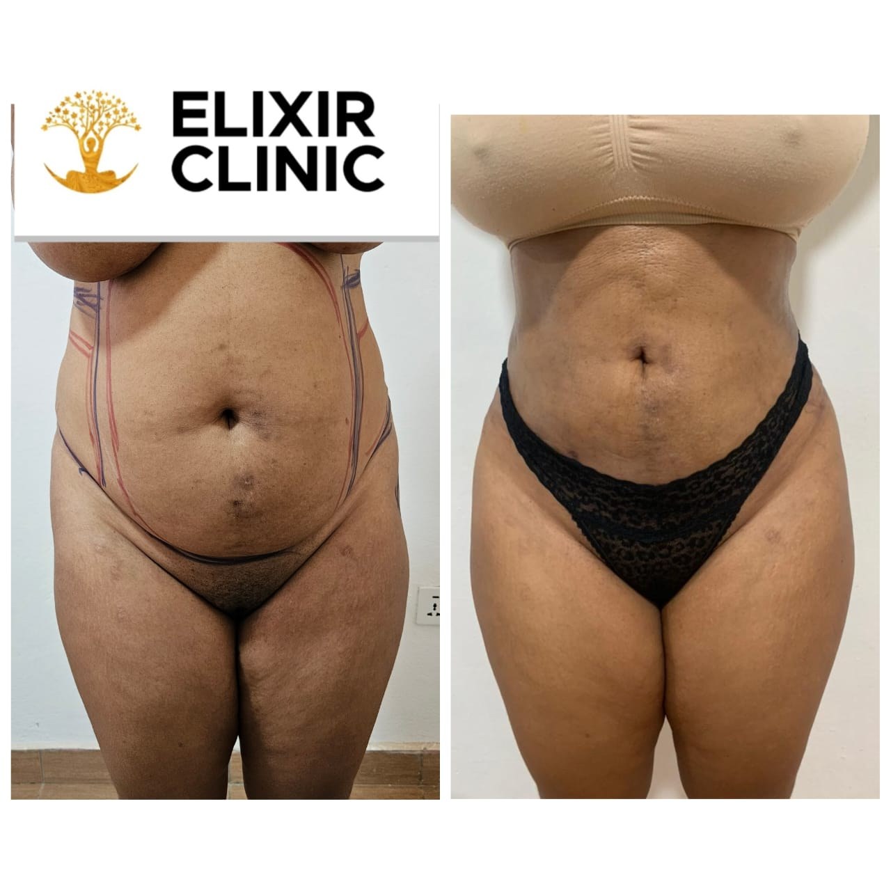 Before and after photographs of a patient’s abdomen at Elixir Clinic, shown side by side.